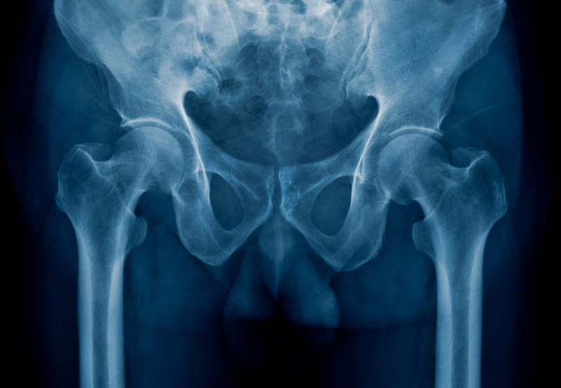 x-ray-of-pelvic-pain-in-need-of-Genitourinary-Fistula-Repair