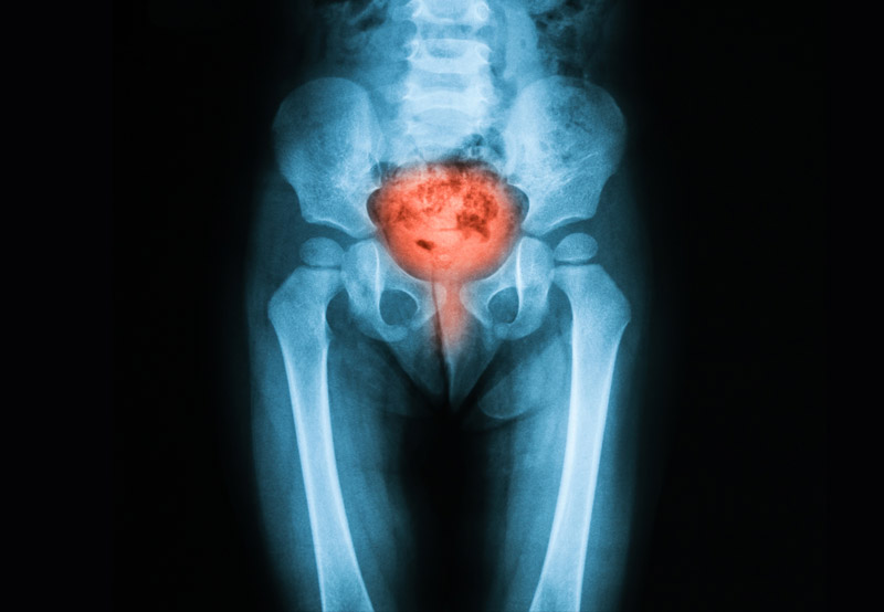 x-ray-of-urinary-tract-infection